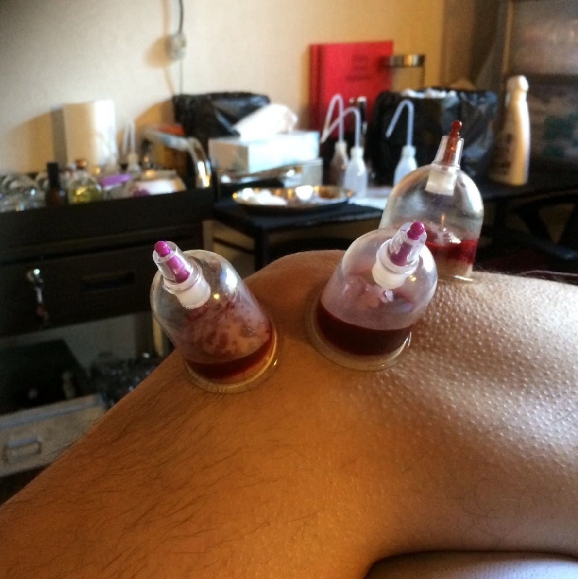 Hijama du genou pour soulager des douleurs