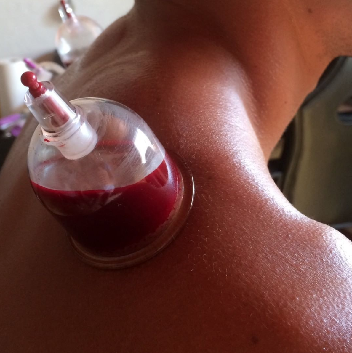 Hijama pour soulager les douleurs du trapèze