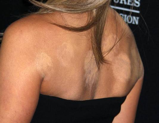 Jennifer Aniston utilise la hijama pour améliorer sa santé