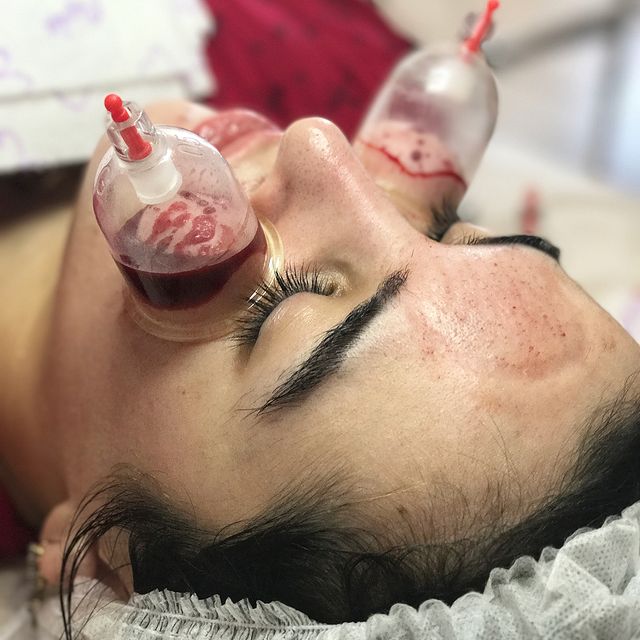 Hijama esthétique des paumettes