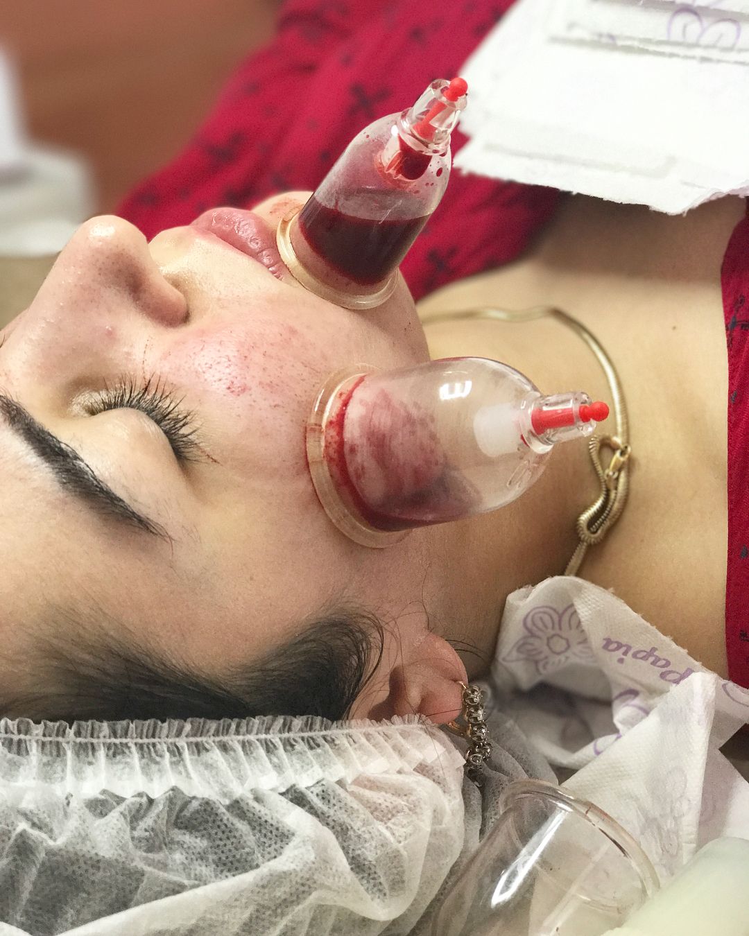 Hijama esthétique joue menton