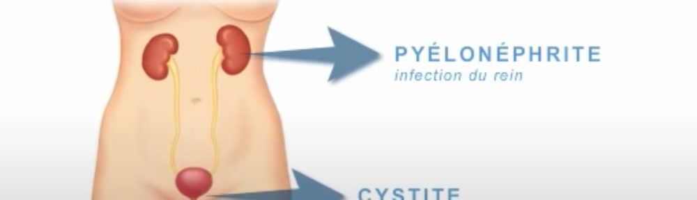 Type d'Infection Urinaire
