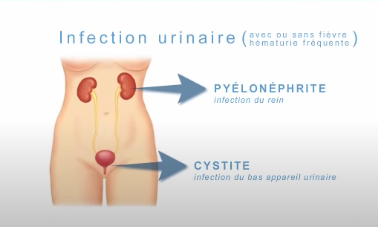 Chaque type d'infection urinaire peut entraîner des signes et des symptômes plus spécifiques, selon la partie de votre appareil urinaire qui est infectée.