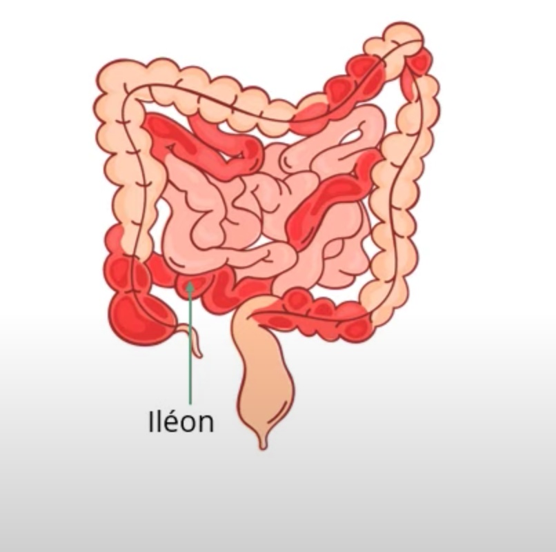 La maladie de Crohn est une maladie qui dure toute la vie et qui est observée principalement dans les pays développés. Elle résulte d'une interaction complexe entre des facteurs génétiques et des perturbations de l'environnement et des voies physiologiques, ainsi que des facteurs environnementaux.