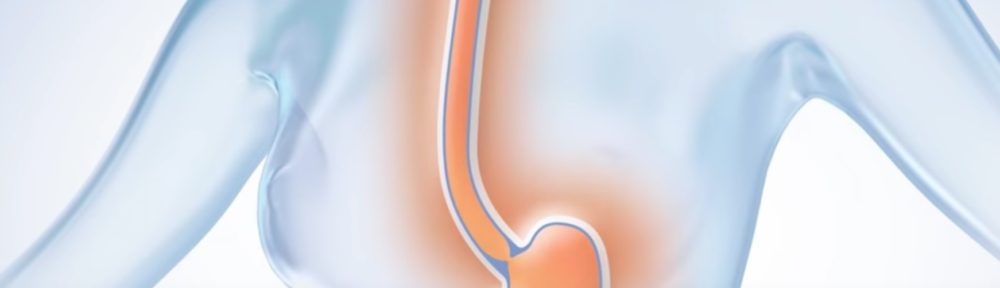Le reflux gastrique ou gastro-œsophagien (RGO) touche 10 à 20 % de la population.