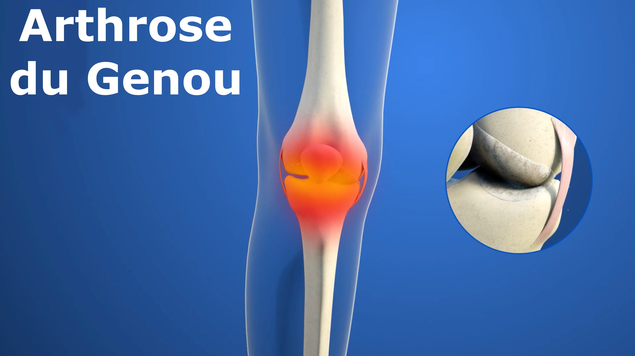L'arthrite est une douleur articulaire d'origine inflammatoire. Il existe des dizaines d'arthrites dont les deux plus connues sont l'arthrose (la plus courante et qui entraîne une usure du cartilage) et la polyarthrite rhumatoïde (qui est une forme plus grave que l'arthrose en ce sens qu'elle va détériorer non seulement le cartilage mais également l'articulation et l'os).