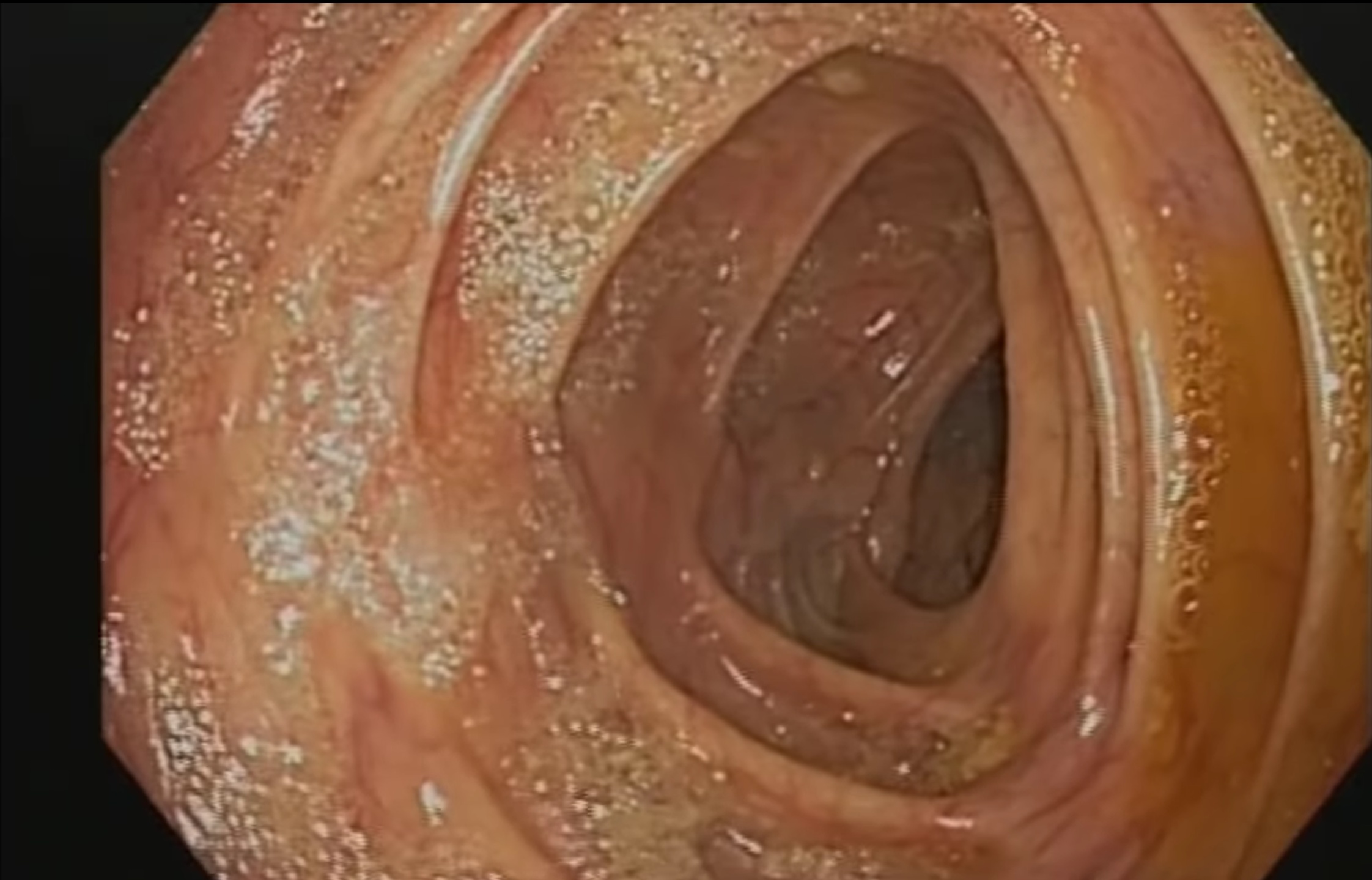 Une coloscopie est une procédure utilisée pour visualiser l'intérieur de votre côlon (gros intestin). Effectuée par un gastro-entérologue,