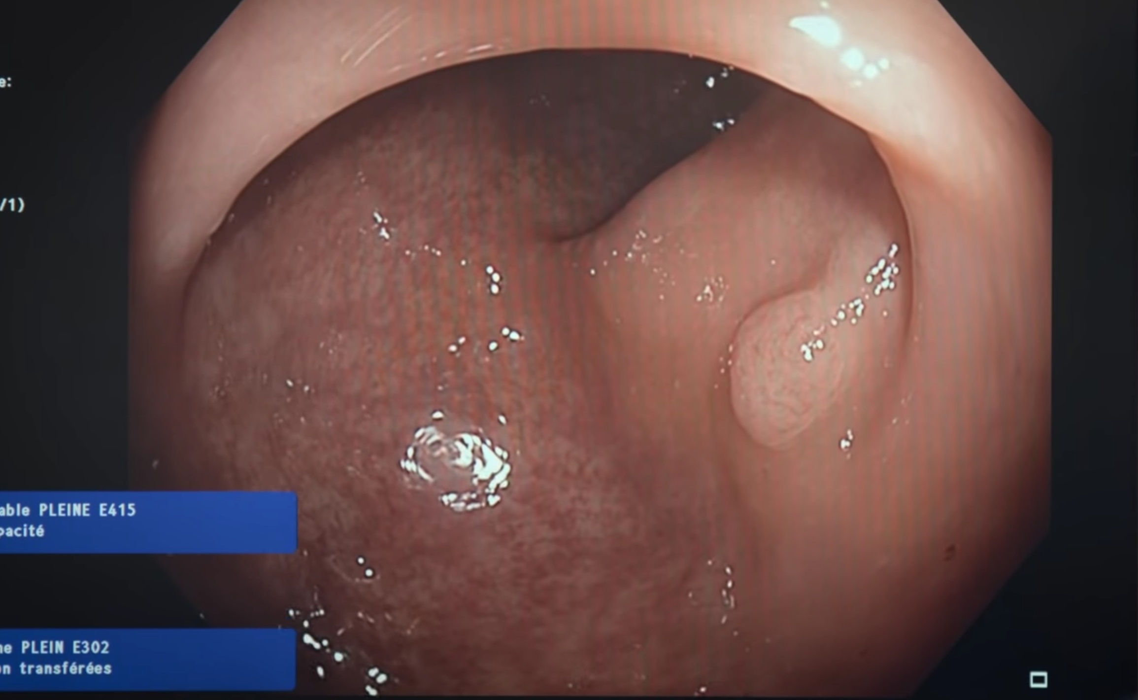 La coloscopie consiste à insérer dans le rectum d'une personne un tube flexible et lumineux équipé d'une minuscule caméra vidéo, appelée coloscope. Le tube est ensuite introduit dans le côlon pour rechercher des anomalies, notamment des polypes