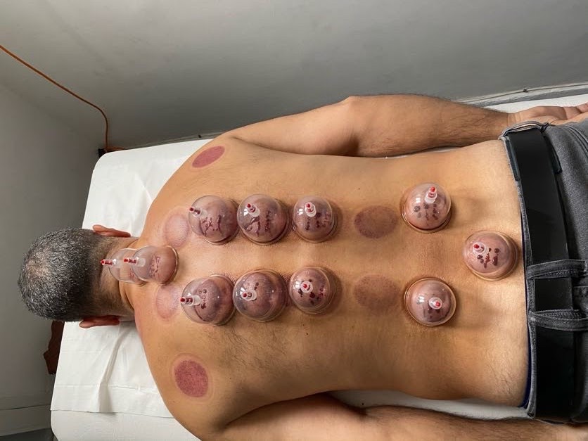 La thérapie par ventouses hijama est une Médecine prophétique