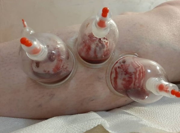 Le jeûne et la hijama