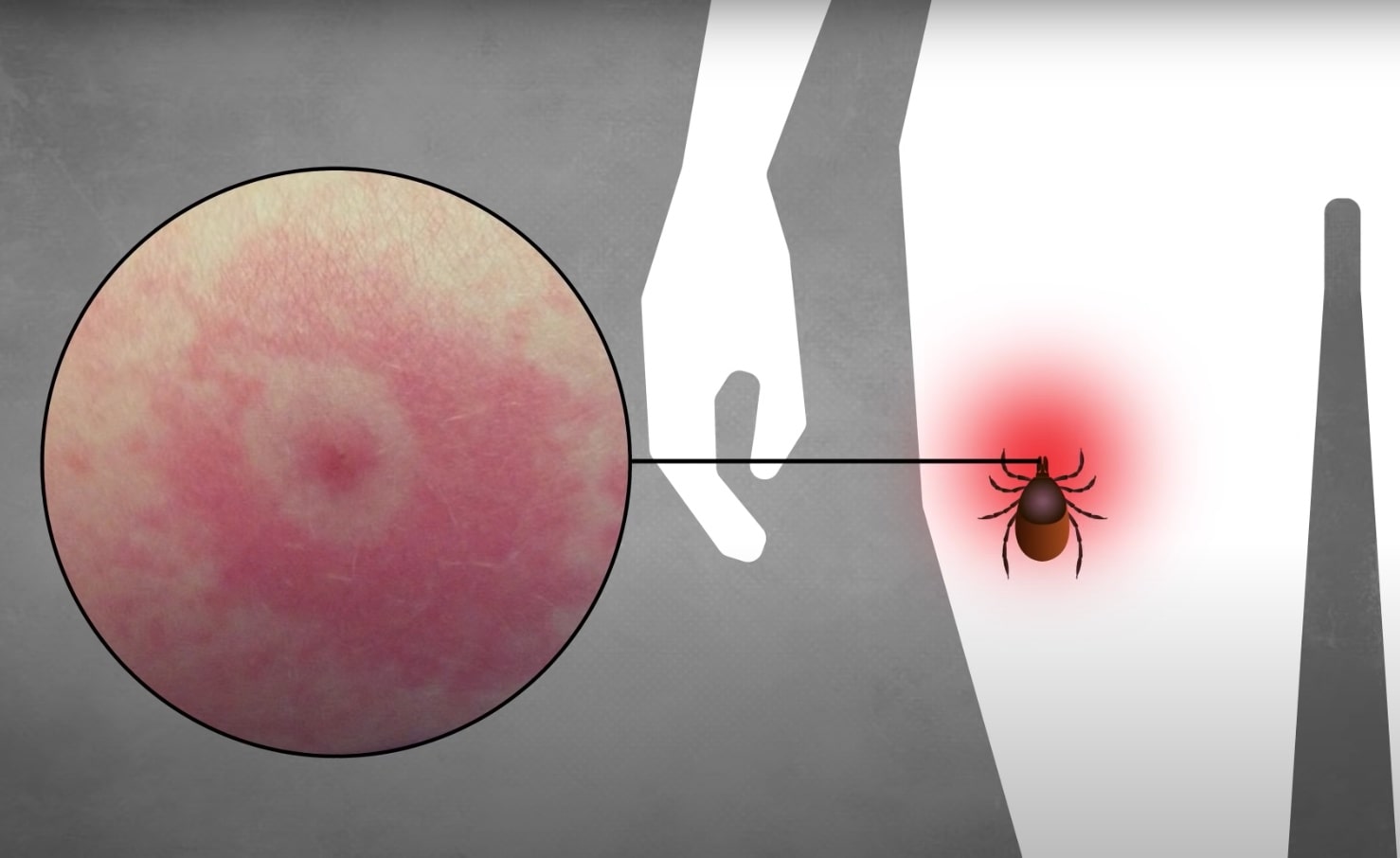 La maladie de Lyme est causée par la bactérie spirochète Borrelia burgdorferi et est transmise à l'homme par une tique infectée. Seulement 50 à 80 % des personnes atteintes de la maladie de Lyme développent une éruption cutanée infectieuse appelée érythème migrant qui ressemble à un œil de bœuf.