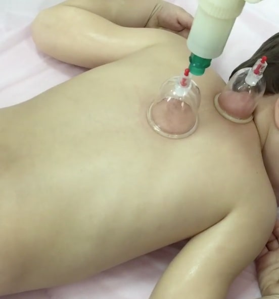 Thérapie par ventouses