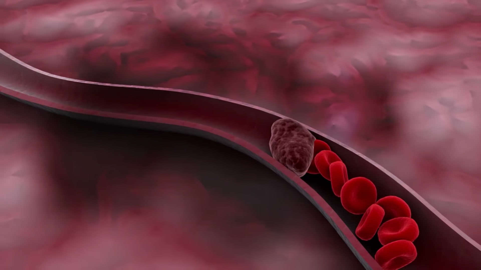 Le dosage des D-dimères est particulièrement utile lorsqu'un professionnel de la santé pense que les symptômes ne sont pas dus à une thrombose veineuse profonde ou à une embolie pulmonaire.