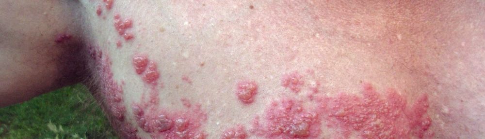 Le zona est causé par le virus varicelle-zona, le même virus qui cause la varicelle. Après la varicelle, le virus reste inactif dans les tissus nerveux près de la moelle épinière et du cerveau.