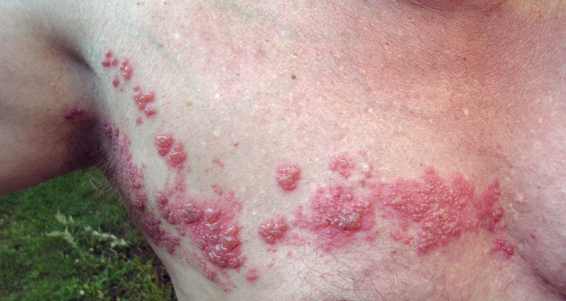 Le zona est causé par le virus varicelle-zona, le même virus qui cause la varicelle.