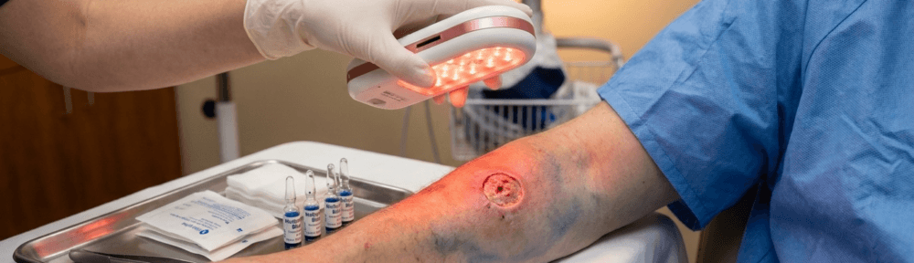 Photographie médicale clinique d'un professionnel de santé appliquant un dispositif LED à lumière rouge sur l'avant-bras d'un patient traité pour une lésion cutanée causée par Leishmania amazonensis, après application topique de bleu de méthylène comme agent photosensibilisant. Plateau stérile avec compresses et ampoules visibles en arrière-plan.